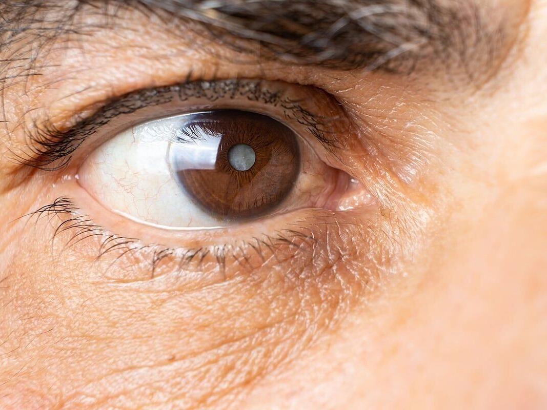 Cataract Surgery Becoming An In-Office Procedure, Experts Say